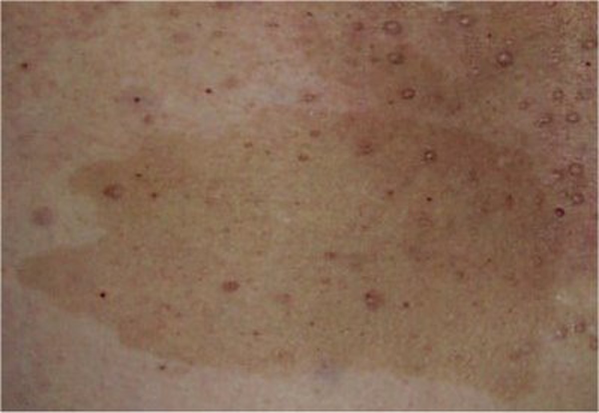 Neurofibromatose de type I