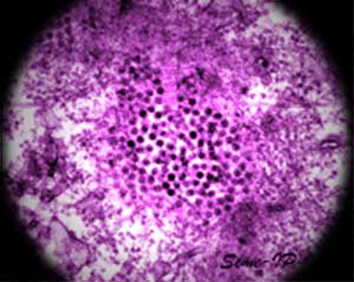 Virus du Nil occidental