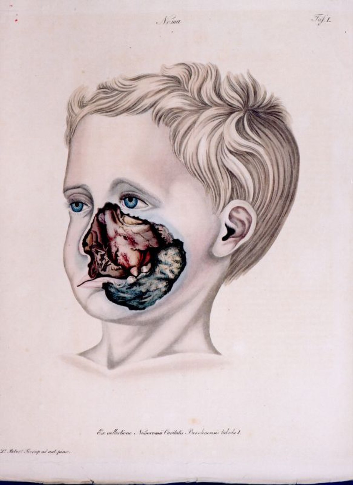 Noma (maladie)