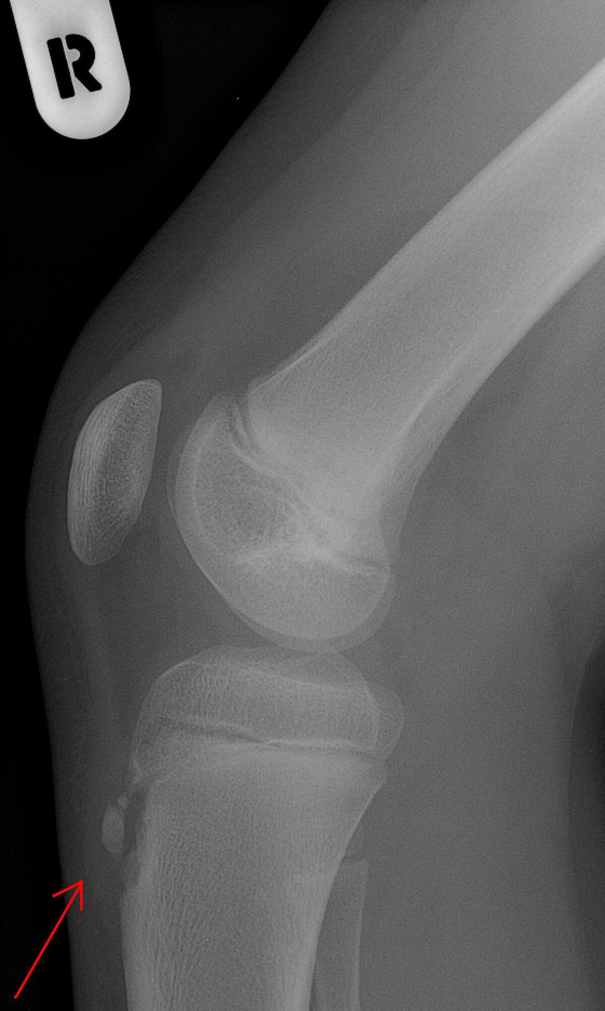 Maladie d'Osgood-Schlatter