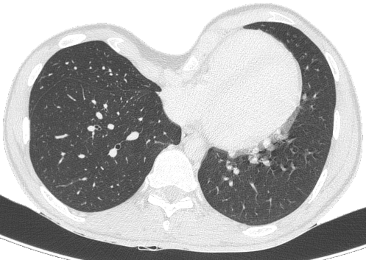 Pectus excavatum