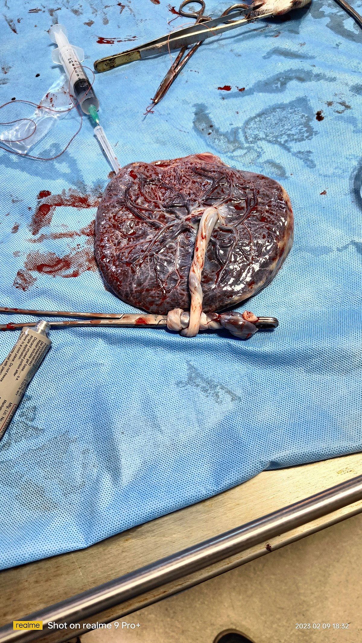 Placenta