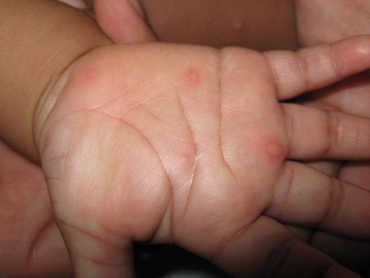 Syndrome pieds-mains-bouche