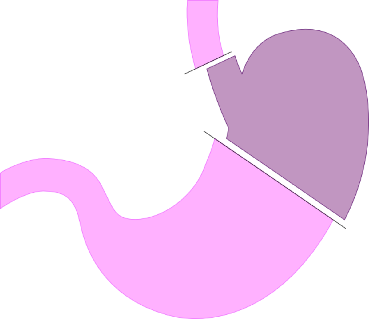 Gastrectomie