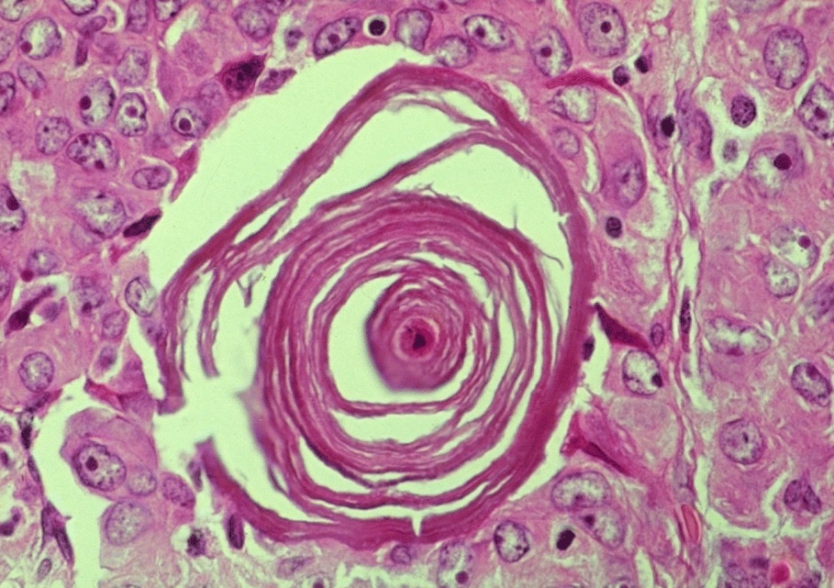 Cancer de la thyroïde