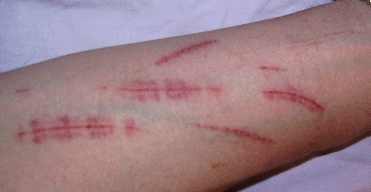 Automutilation