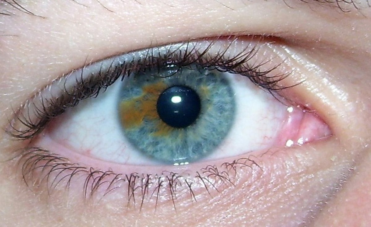 Hétérochromie