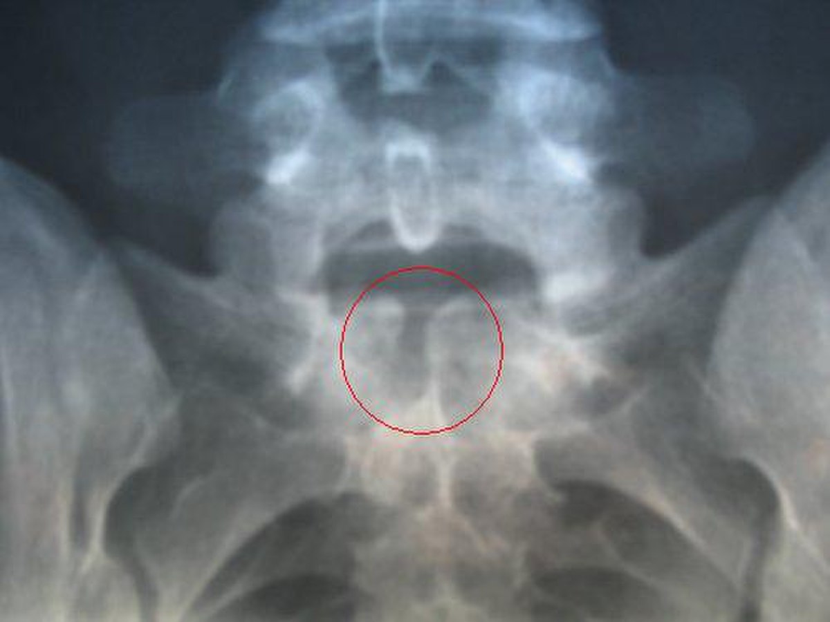 Spina bifida