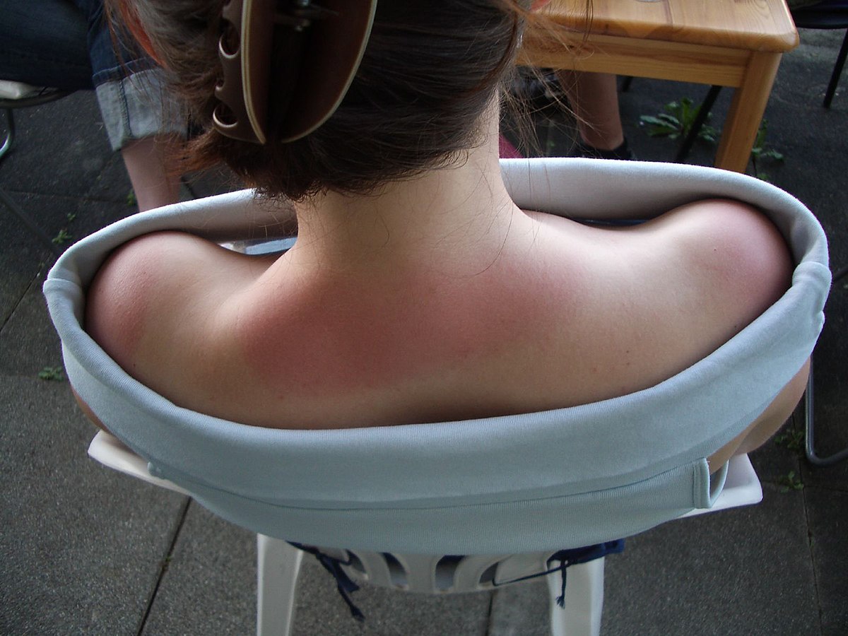 Coup de soleil