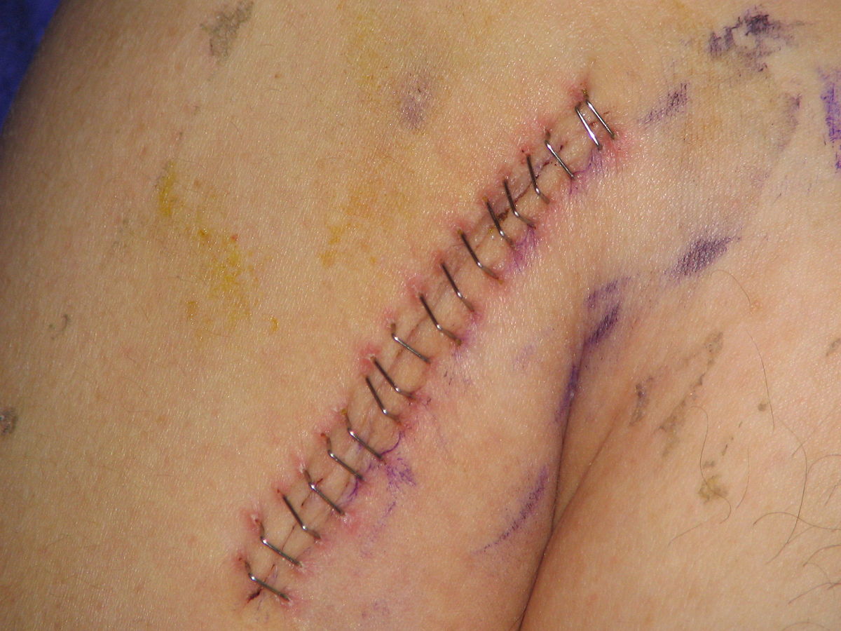 Suture (médecine)