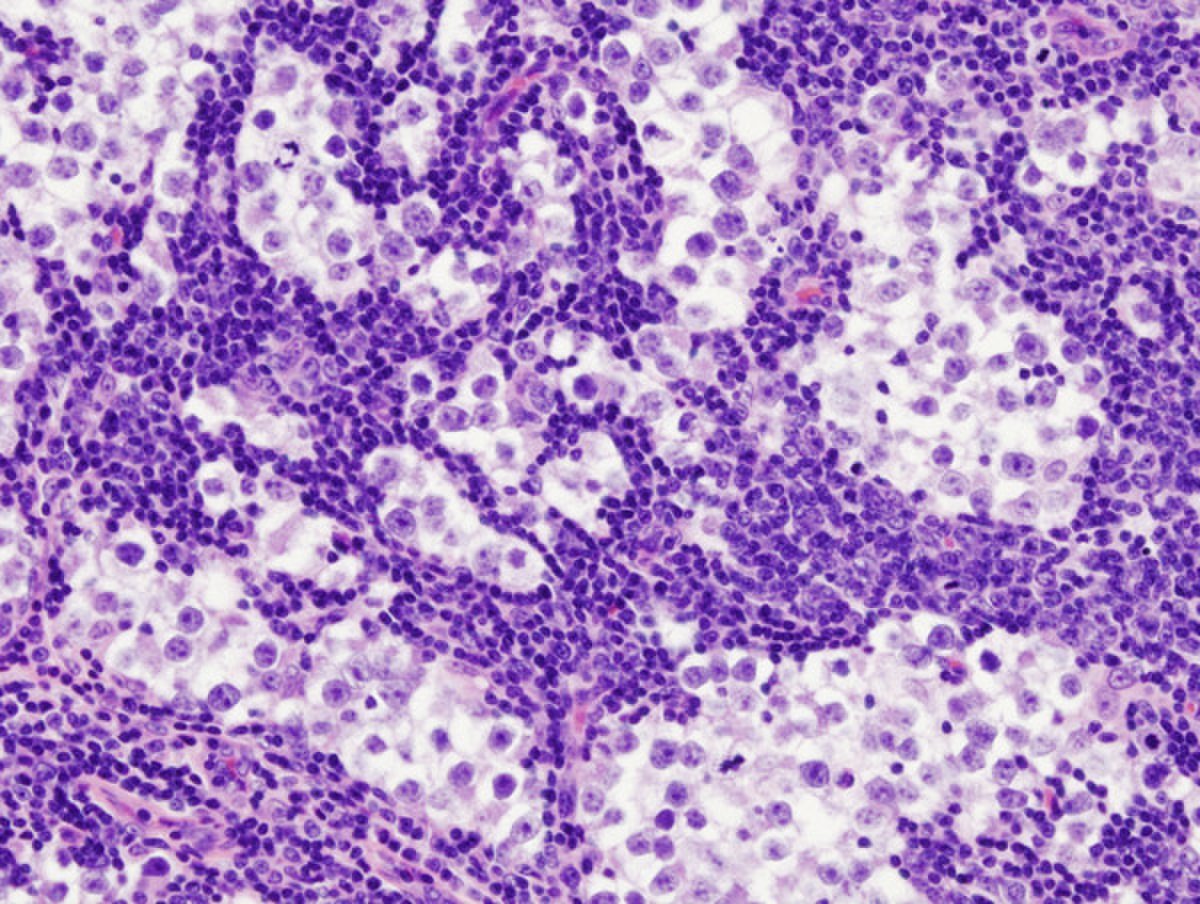 Cancer du testicule