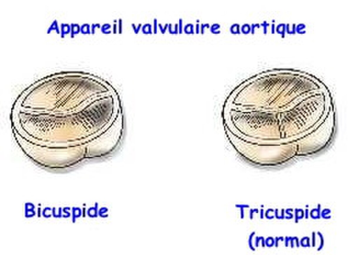 Bicuspidie valvulaire aortique