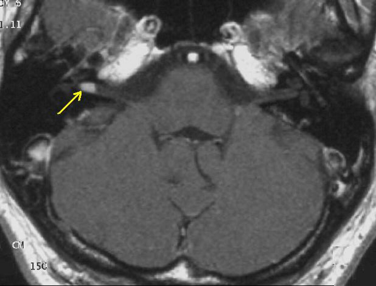 Neurofibromatose de type II