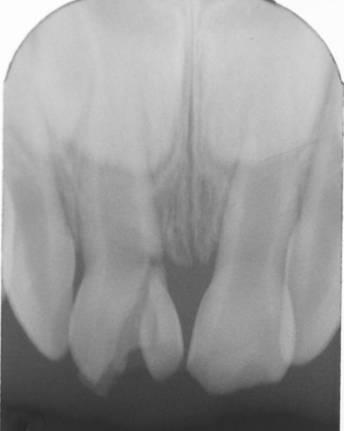 Radio fracture couronne racine.jpg