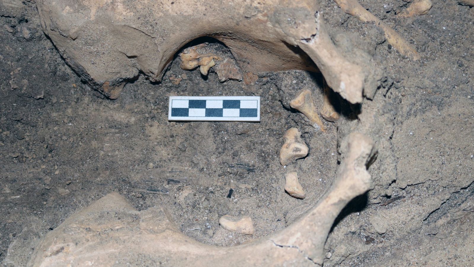 Des dents poussent dans ses ovaires... et sont découvertes 3000 ans plus tard
