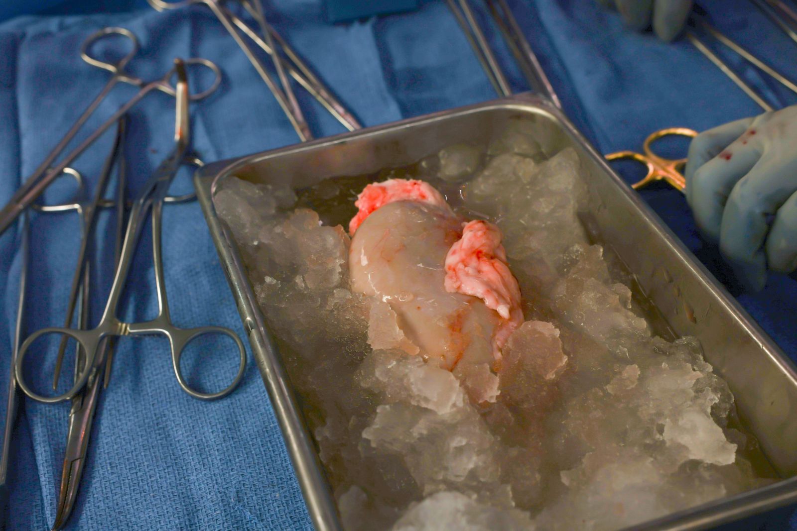 Um rim de porco geneticamente modificado transplantado em um humano: rumo a órgãos ilimitados?