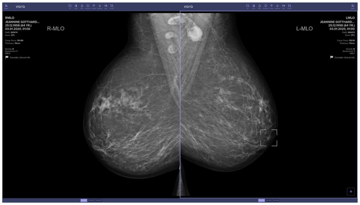 L'IA détecte mieux le cancer du sein que l'Homme 🩺