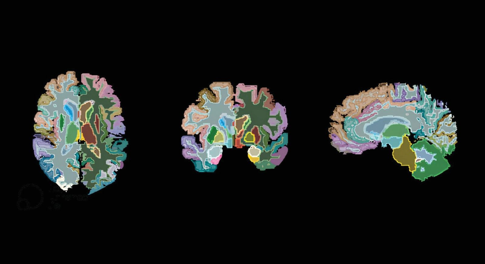 ADHD linked to dementia 🧠