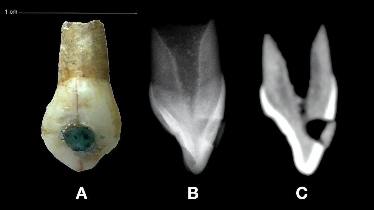 🦷 Première: découverte d'incrustations de jade dans des dents d'enfants mayas