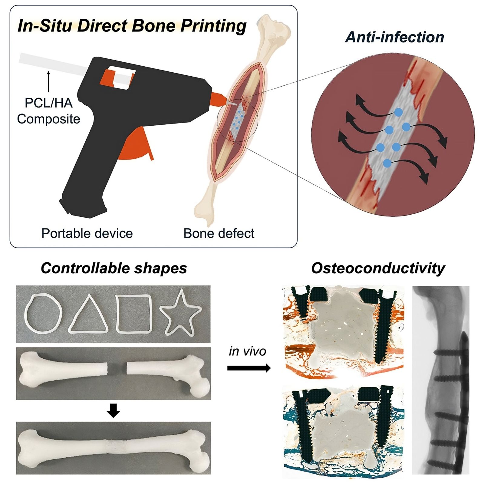 🦴 Ce pistolet à colle répare les fractures osseuses