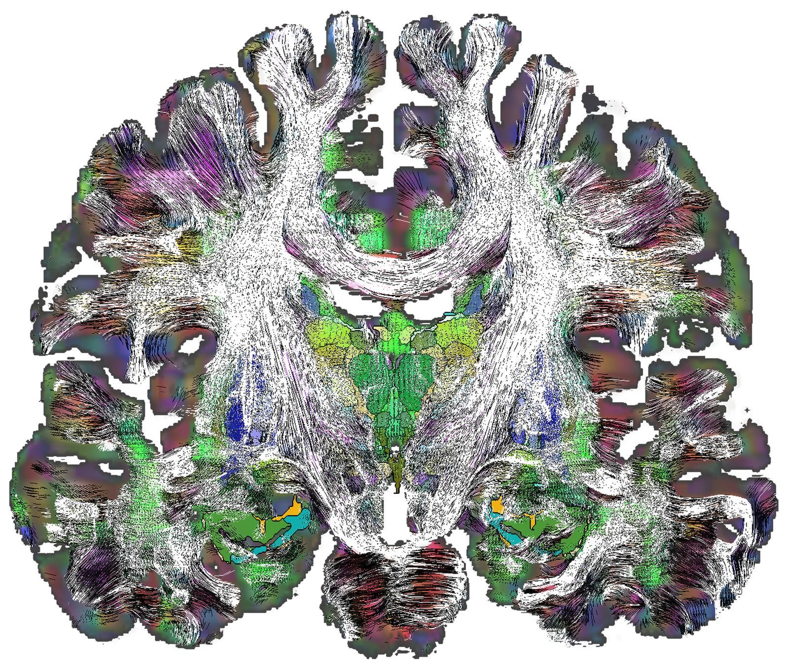 à Crises d'épilepsie : des boucles dans le cerveau
