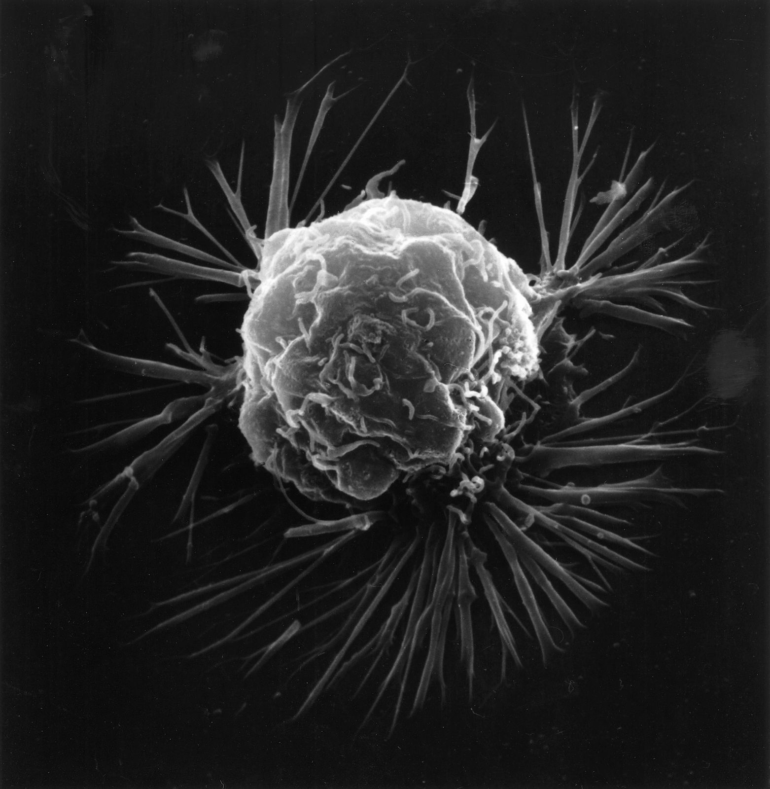 🧬 Cancer : des tumeurs exploitent des antioxydants pour survivre