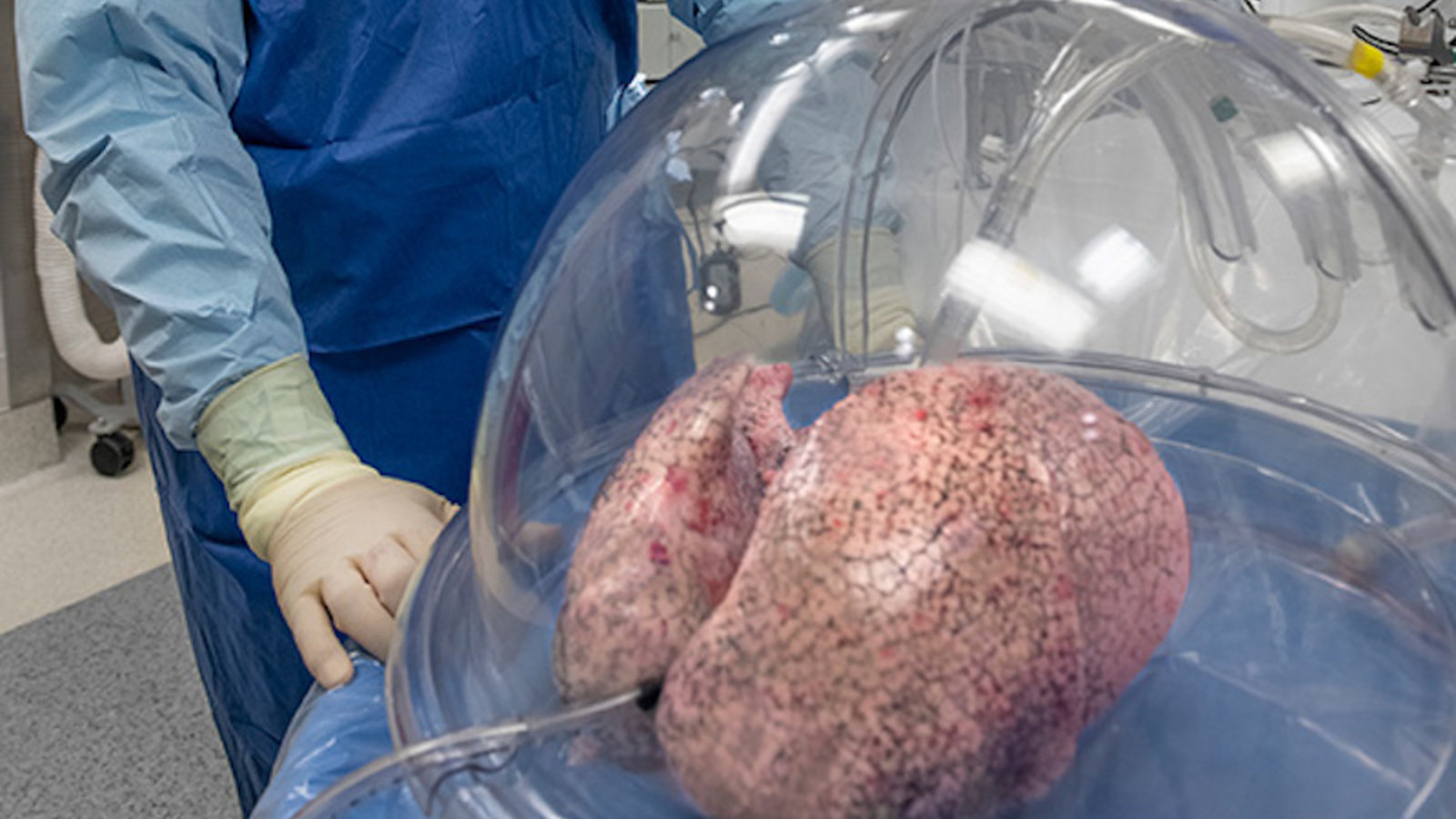 Transplantations: une cure de jeunesse pour les poumons