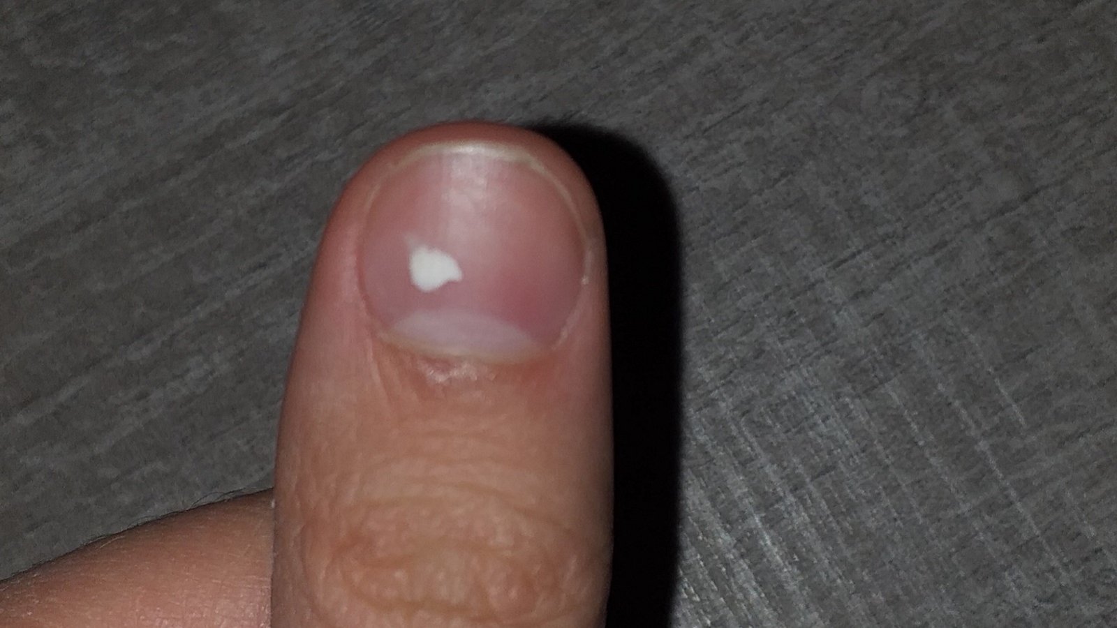 Les taches blanches sur les ongles révélatrices d'un manque de calcium ?
