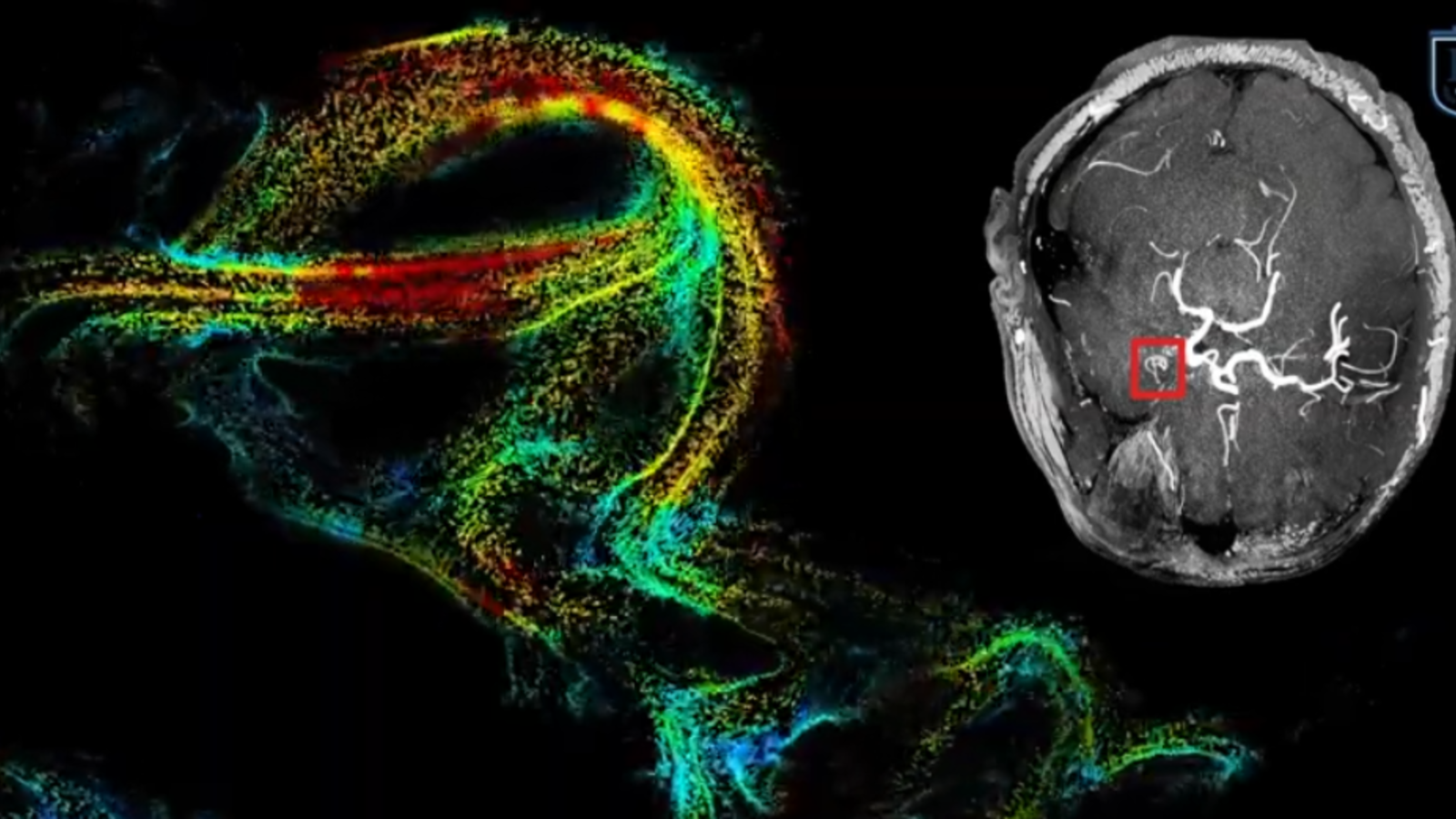 La microscopie de localisation ultrasonore pour voir la circulation sanguine comme jamais dans le cerveau