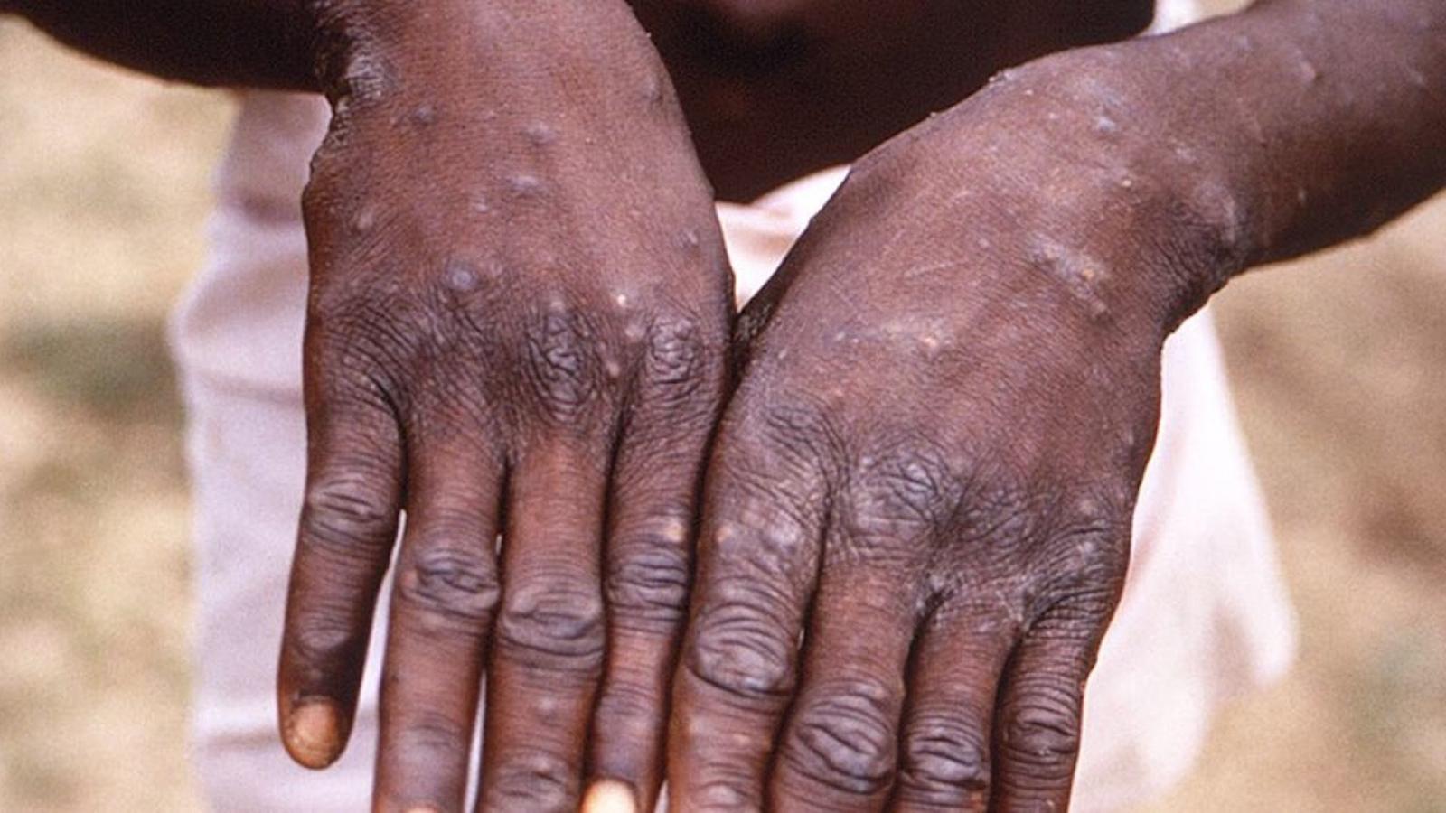 Variole du singe: ce que l’on sait
