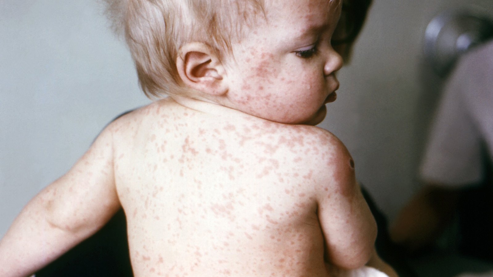 Rougeole: le problème des non-vaccinés