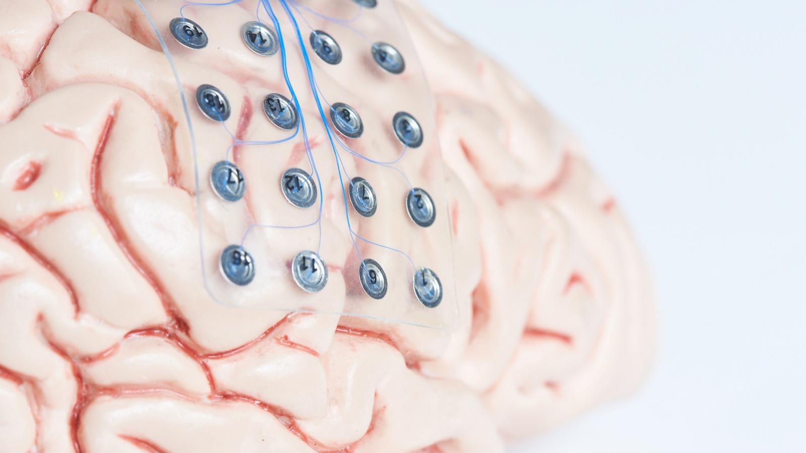 Un implant électronique dans le cerveau pour bientôt ?