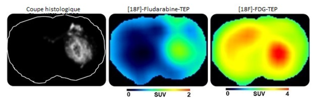 Vers un meilleur diagnostic des cancers du cerveau