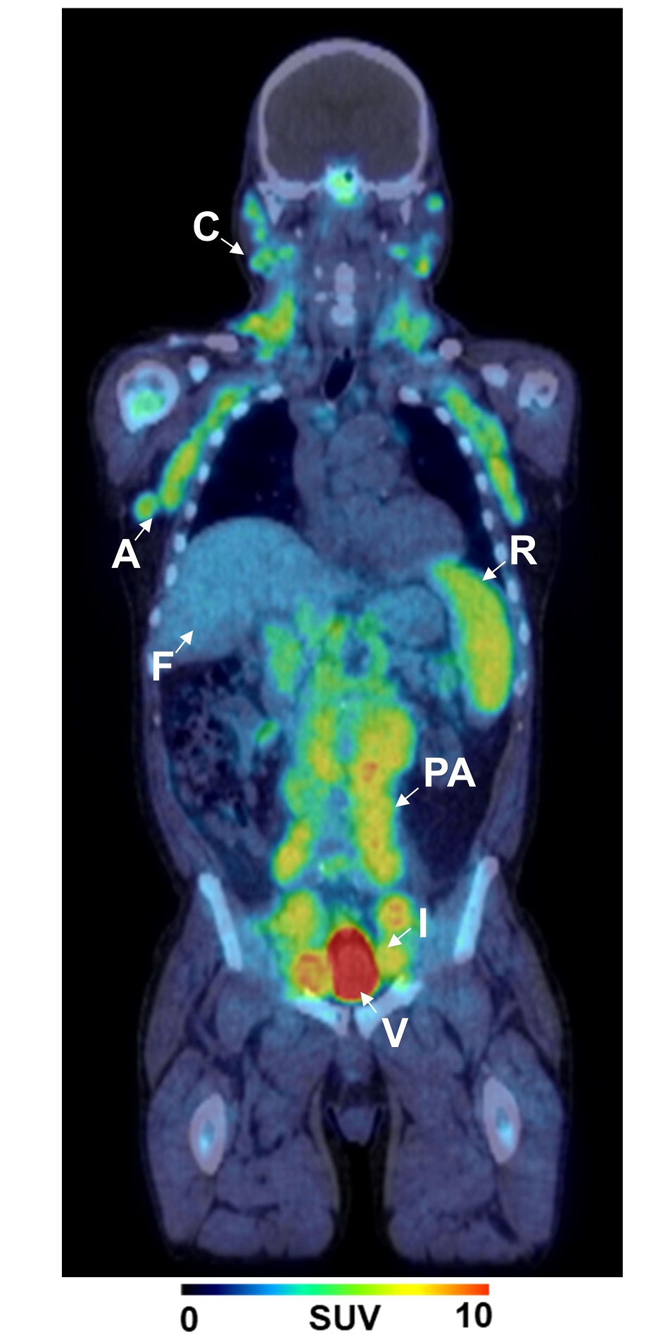 Améliorer la visualisation des cellules tumorales pour les maladies lymphoprolifératives