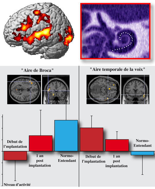 L'adaptation du cerveau à la surdité profonde