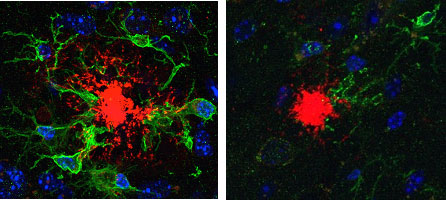 De nouvelles pistes de recherches sur la maladie d'Alzheimer et son traitement