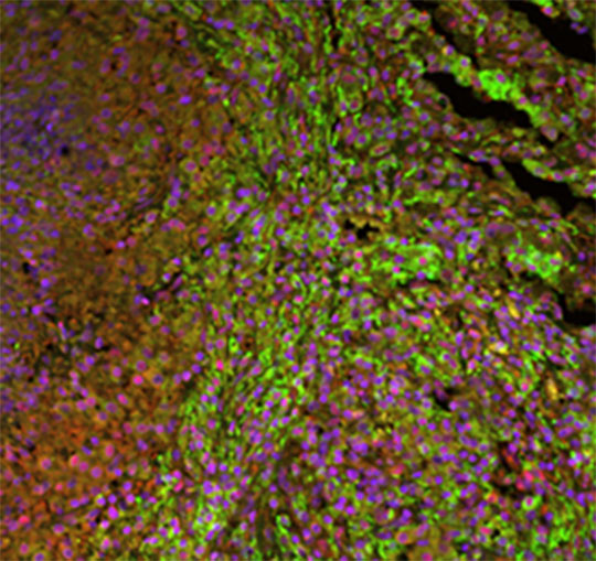 Tuberculose: cellules immunitaires et prolifération du bacille