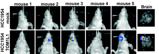 Association dans la progression métastatique du cancer du sein