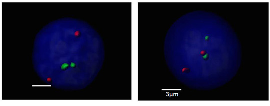Pourquoi, malgré les trithérapies, des patients porteurs d'HIV continuent-ils de développer certains lymphomes ?