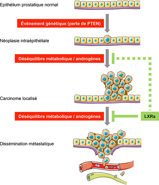 Cancer de la prostate: les récepteurs LXRs contre-attaquent !
