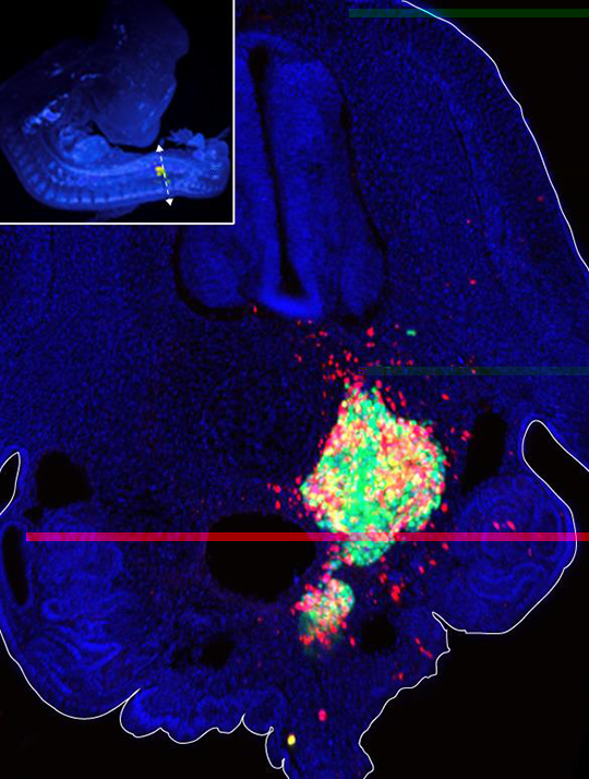 Un embryon aviaire pour retracer l'histoire d'un cancer métastatique dévastateur de l'enfant