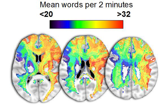 La face cachée des lésions cérébrales