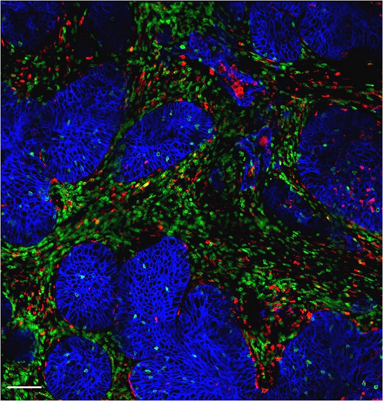 Cancer: améliorer l'immunothérapie en éliminant les macrophages tumoraux