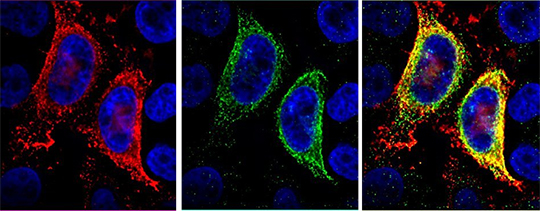 Cancer du sein: un duo de récepteurs envisagé comme piste thérapeutique