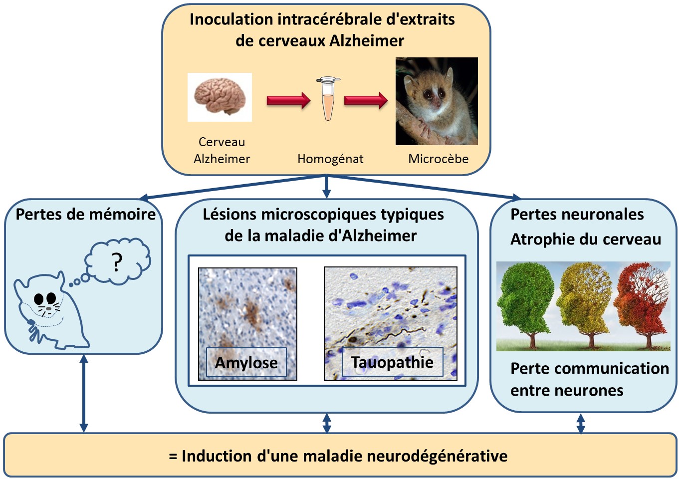 Transmission d'une pathologie neurodégénérative par des cerveaux Alzheimer