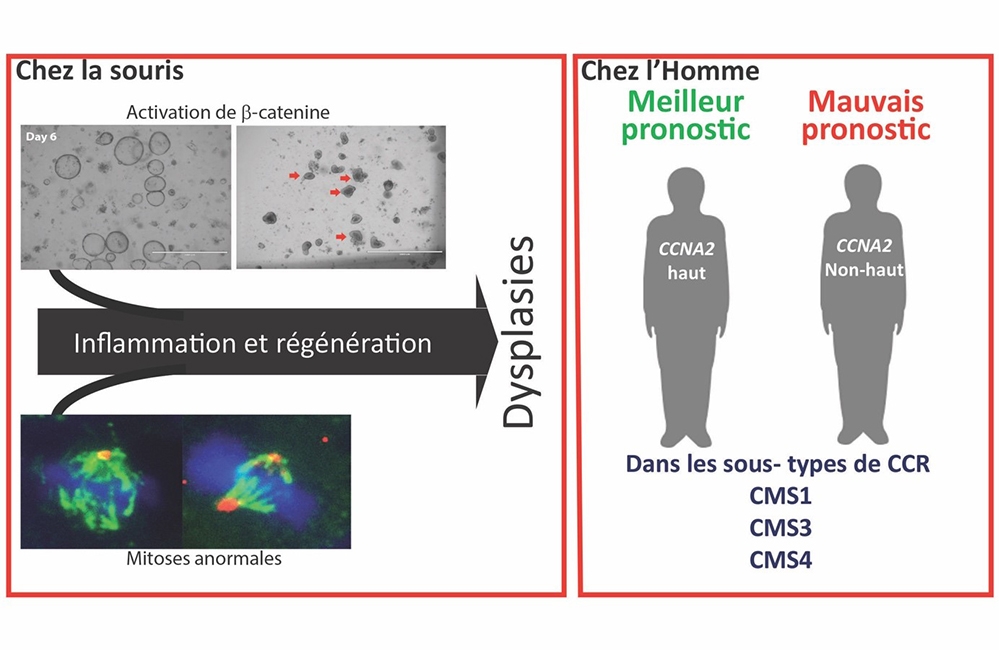 Un nouveau marqueur de pronostic pour le cancer colorectal
