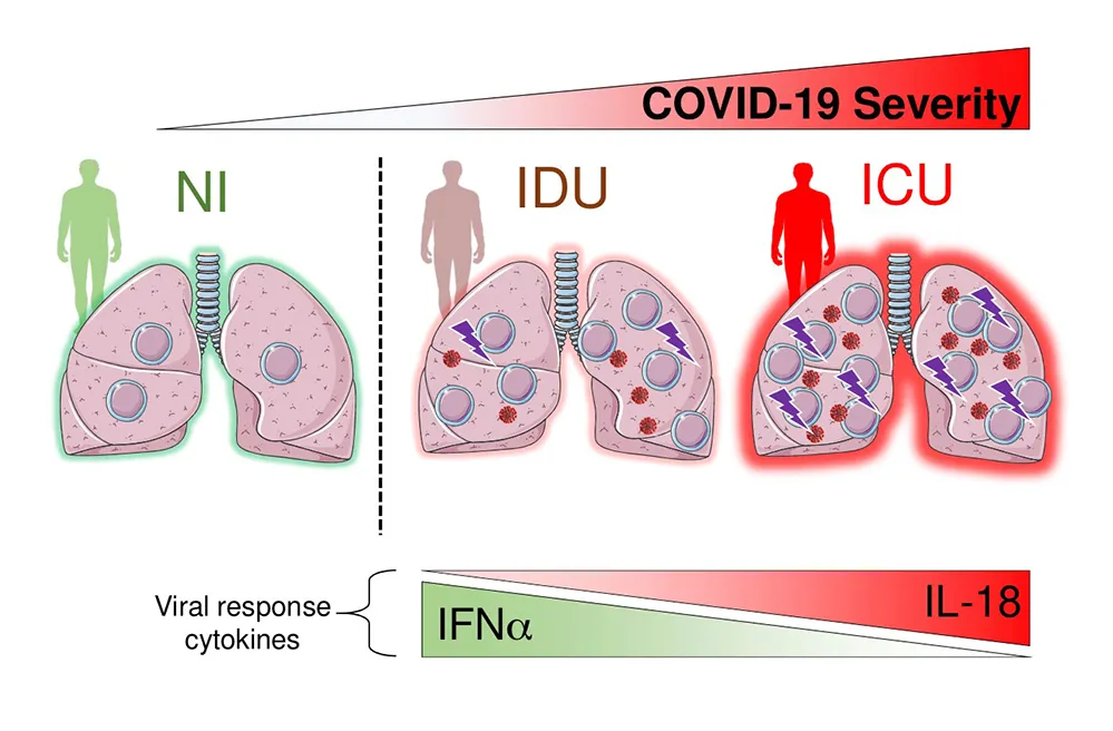 COVID-19: des cellules immunitaires associées aux muqueuses impliquées dans la sévérité de l’infection