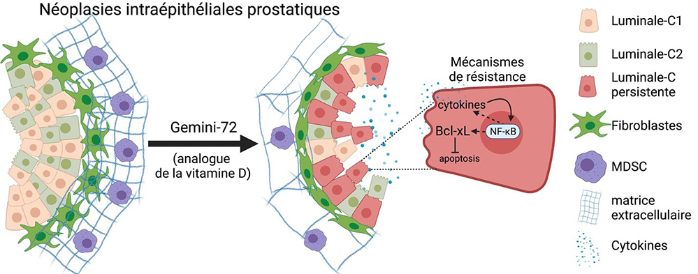 Cancer de la prostate: effets bénéfiques et limites de la Vitamine D