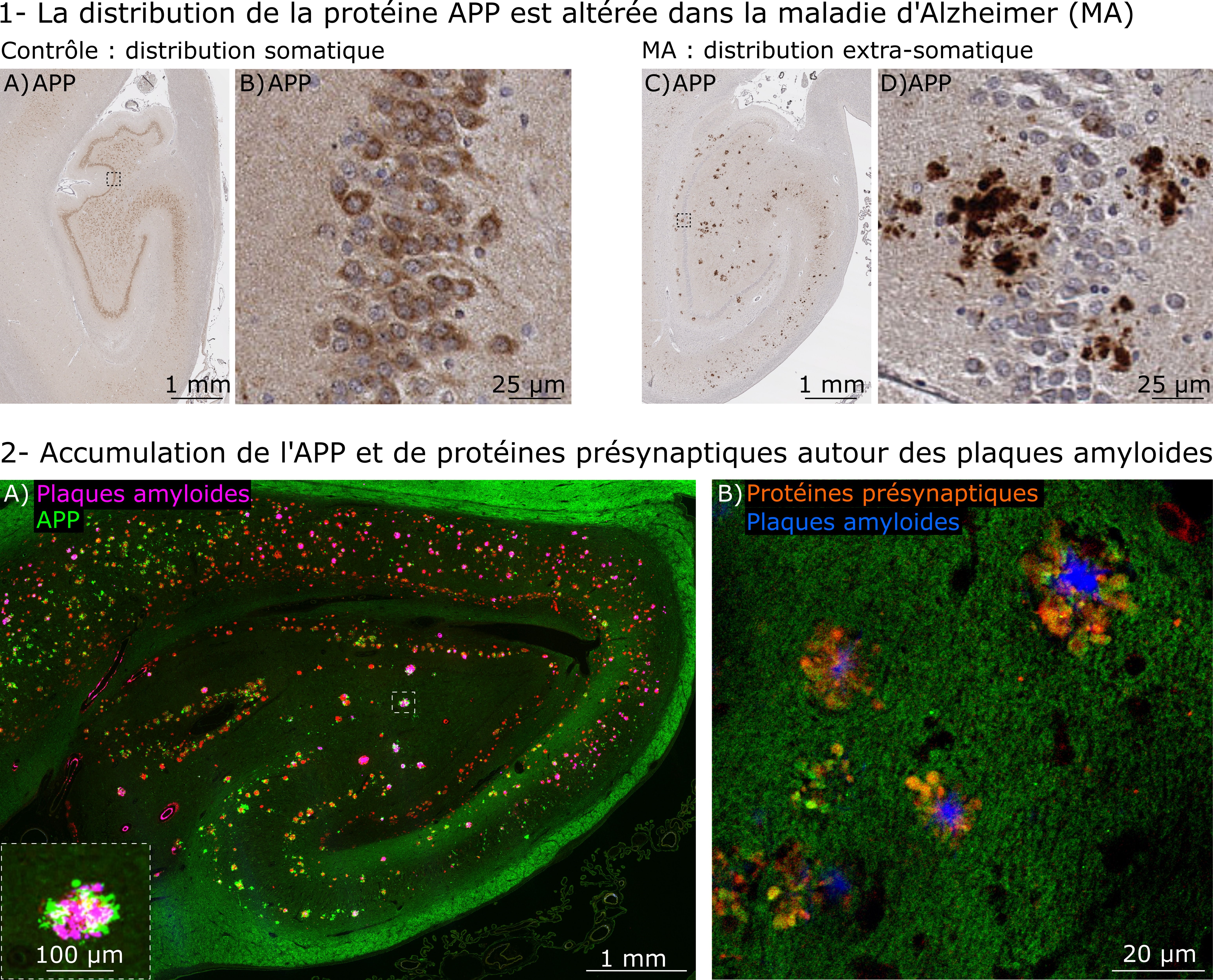 Maladie d’Alzheimer: perturbations synaptiques autour des plaques amyloïdes