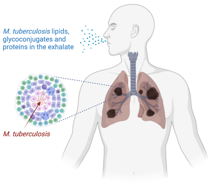 Détecter la tuberculose directement par prélèvement de l'air exhalé